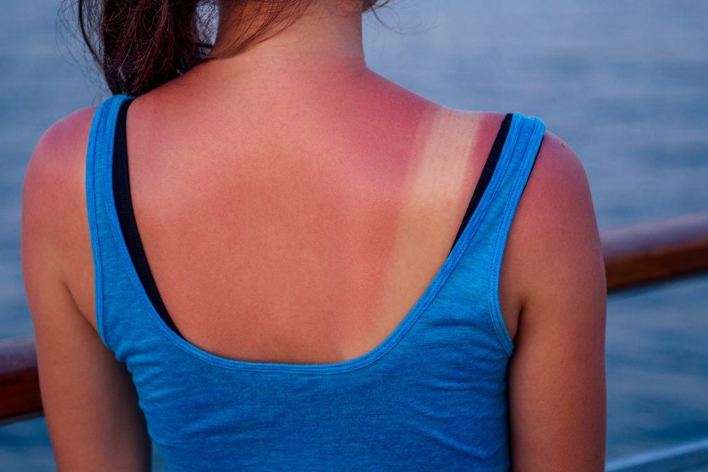 Zonneallergie: symptomen, oorzaken en behandeling
